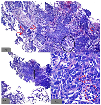 Carcinoma indiferenciado