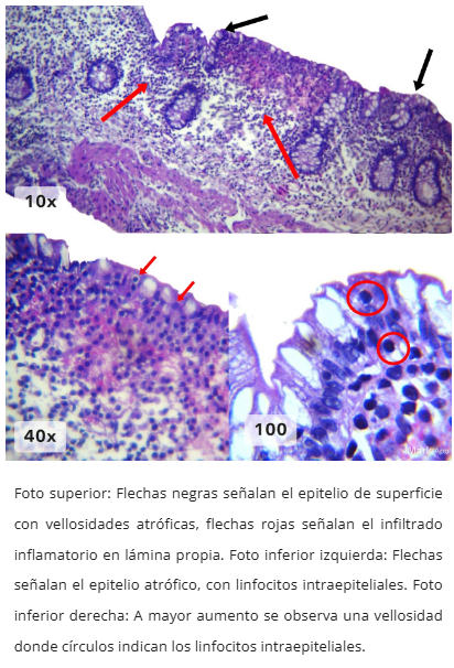Ileitis con linfocitosis intraepitelial
