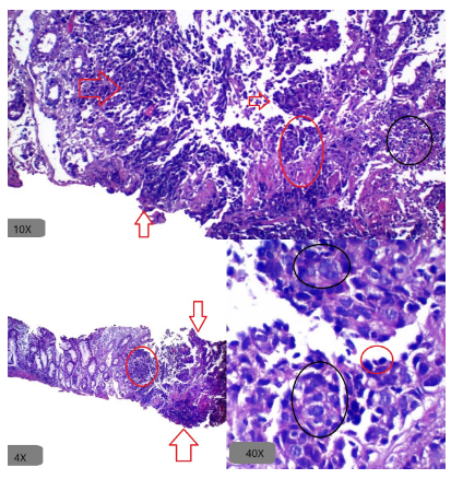 Carcinoma indiferenciado