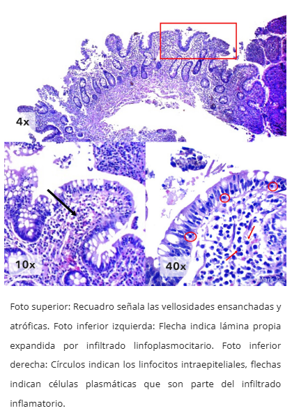 Linfocitosis intraepitelial