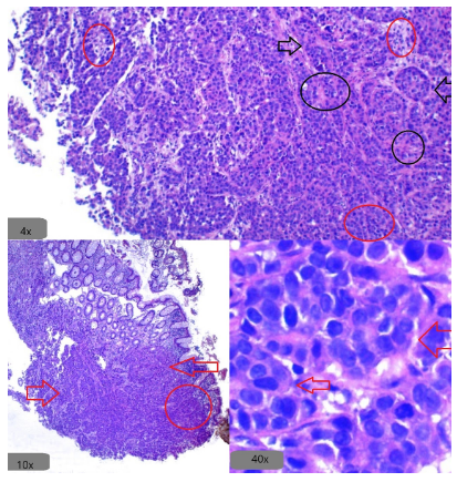 Carcinoma indiferenciado