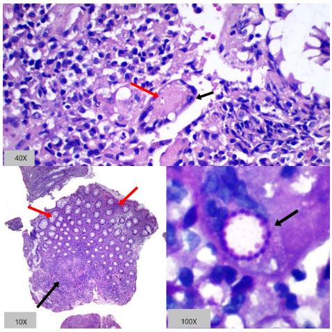 Colitis por Paracoccidioides