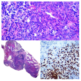 Carcinoma escamoso