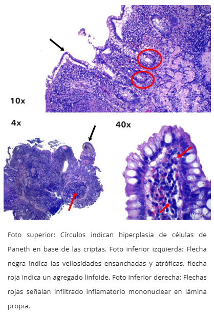 Microscopía Crohn