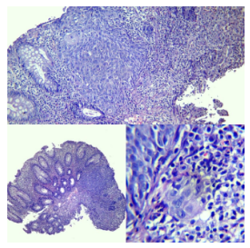 Carcinoma escamoso