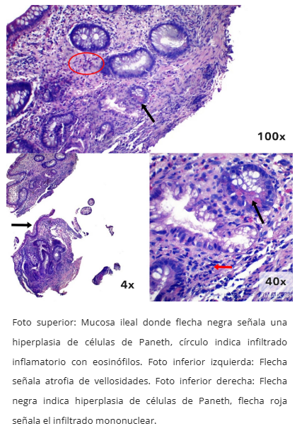 Patrón inflamatorio