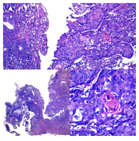 Carcinoma escamoso