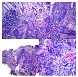 Carcinoma escamoso