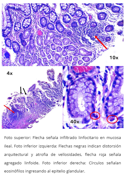 Granulomas