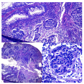 Carcinoma escamoso