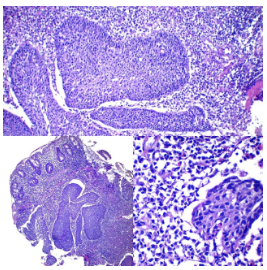 Carcinoma escamoso
