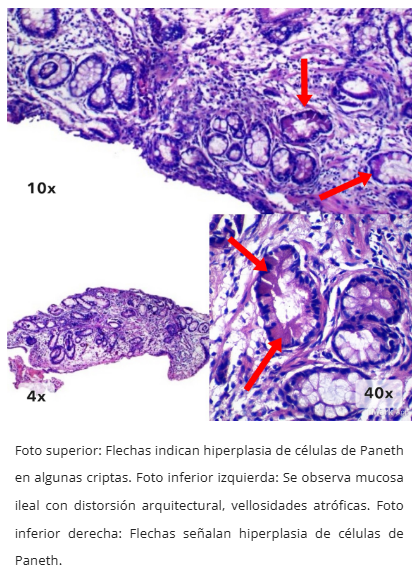 Fibrosis