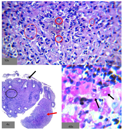 Colitis por Cryptococo - Vista microscópica