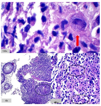 Colitis por CMV - Cambios citopáticos