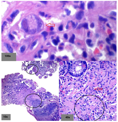 Inmunohistoquímica CMV