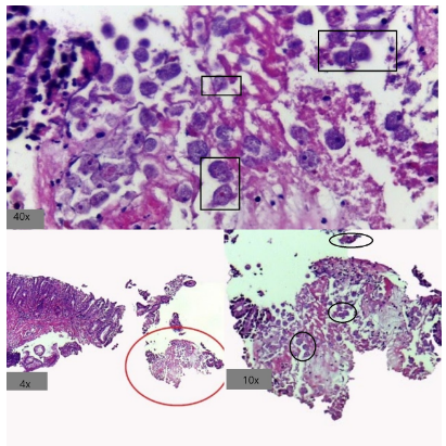 Colitis Amebiásica - Vista endoscópica
