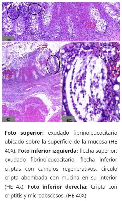 Microscopía de colitis pseudomembranosa