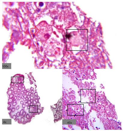Patrón inflamatorio en colitis amebiásica