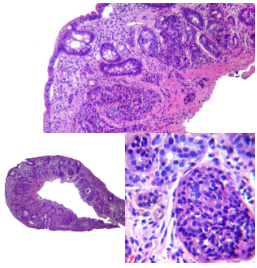 Neoplasia neuroendocrina