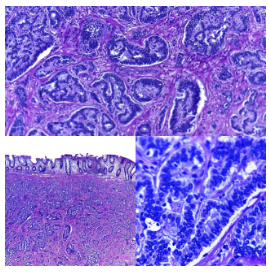Neoplasia neuroendocrina