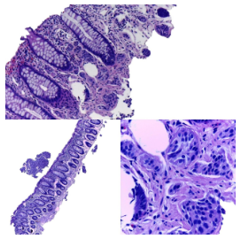 Neoplasia neuroendocrina