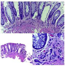 Neoplasia neuroendocrina