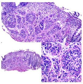 Neoplasia neuroendocrina