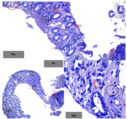 Endoscopía de colitis isquémica