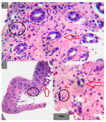 Microscopía de colitis isquémica