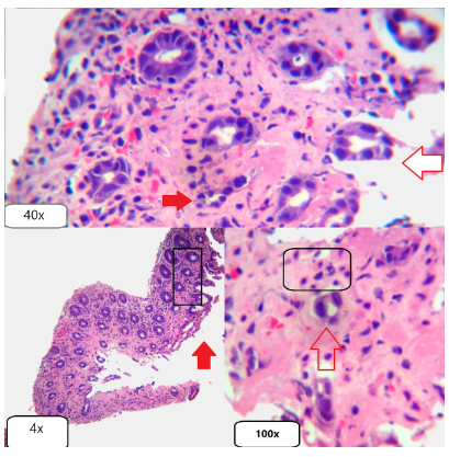Macrófagos con hemosiderina