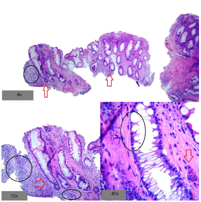 Endoscopía de prolapso rectal