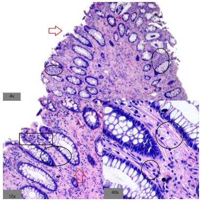 Hiperplasia fibromuscular