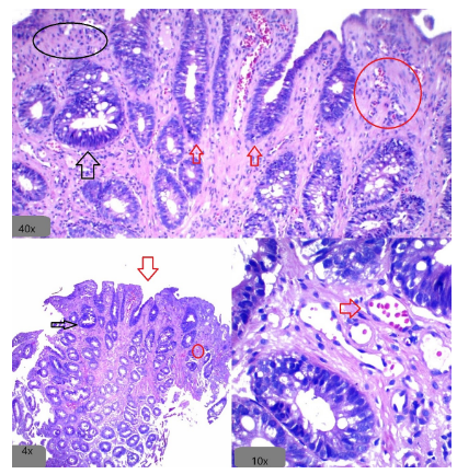 Hiperplasia muscularis mucosae