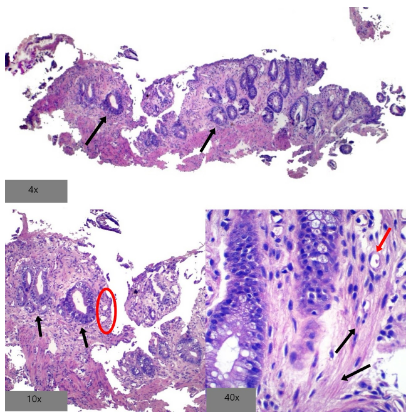 Angiogénesis reparativa