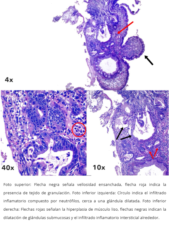 Papilitis