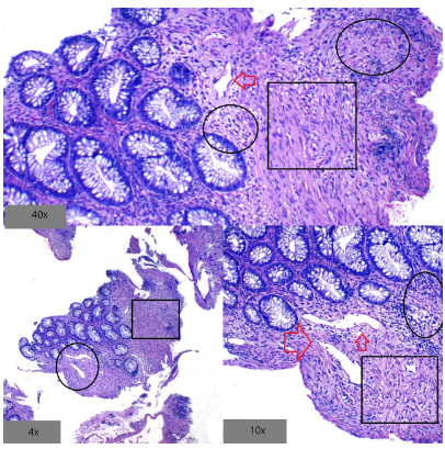 Endoscopía de proctitis actínica