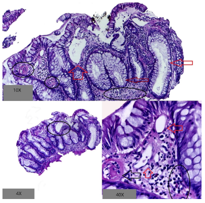 Ectasia vascular
