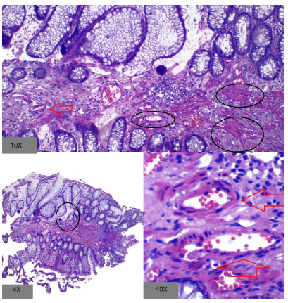 Fibrosis estromal