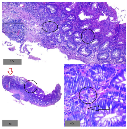 Endoscopía de colitis diverticular