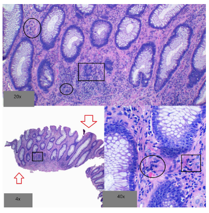 Microscopía de colitis diverticular