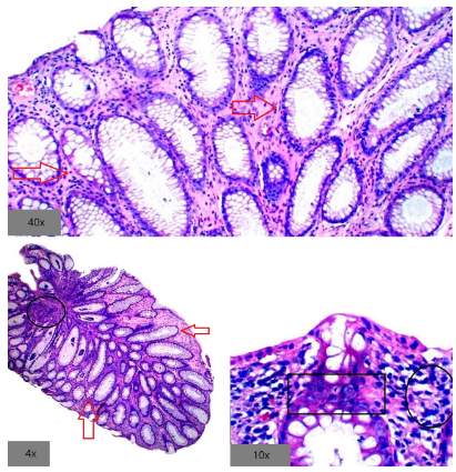 Hiperplasia fibromuscular