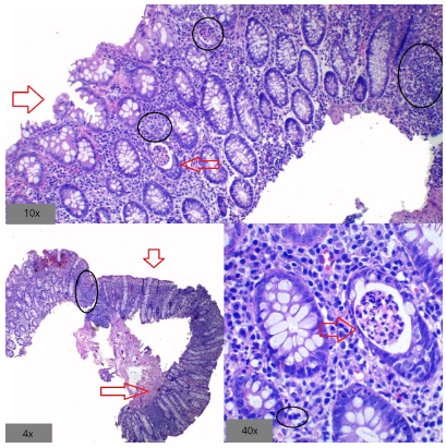 Distribución peridiverticular