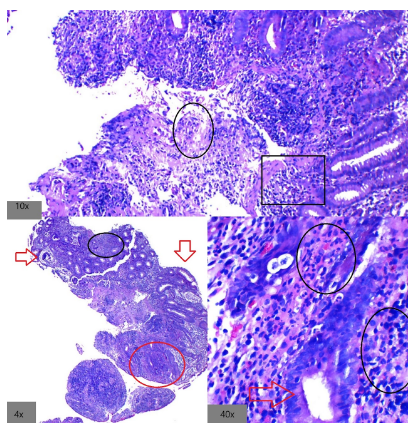 Endoscopía de colitis por derivación