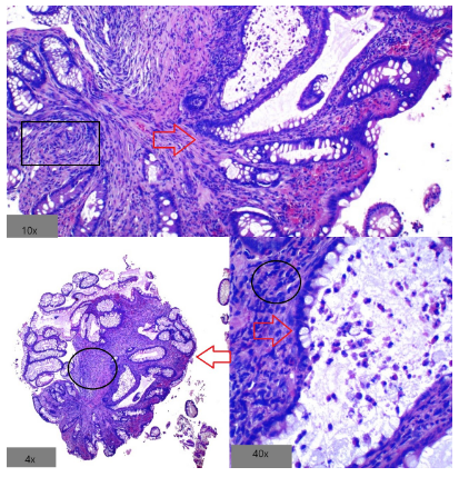 Microscopía de colitis por derivación