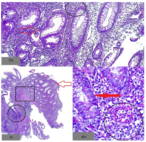 Cambios epiteliales en colitis por derivación