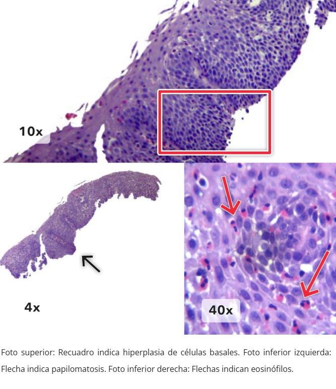 Endoscopía de colitis por MMF