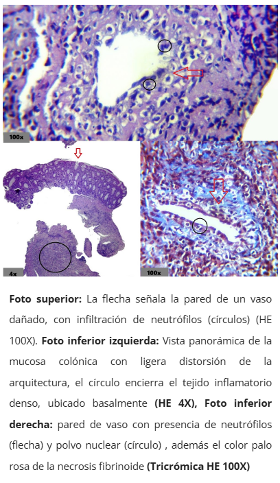 Vasculitis en colon