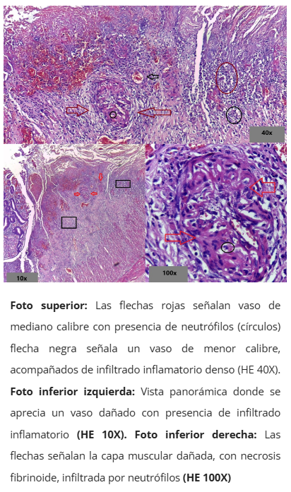 Poliarteritis nodosa