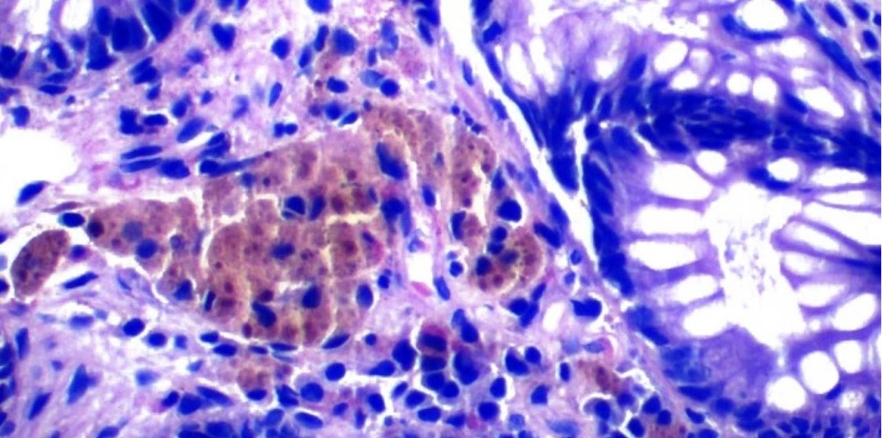 Patología de Colon