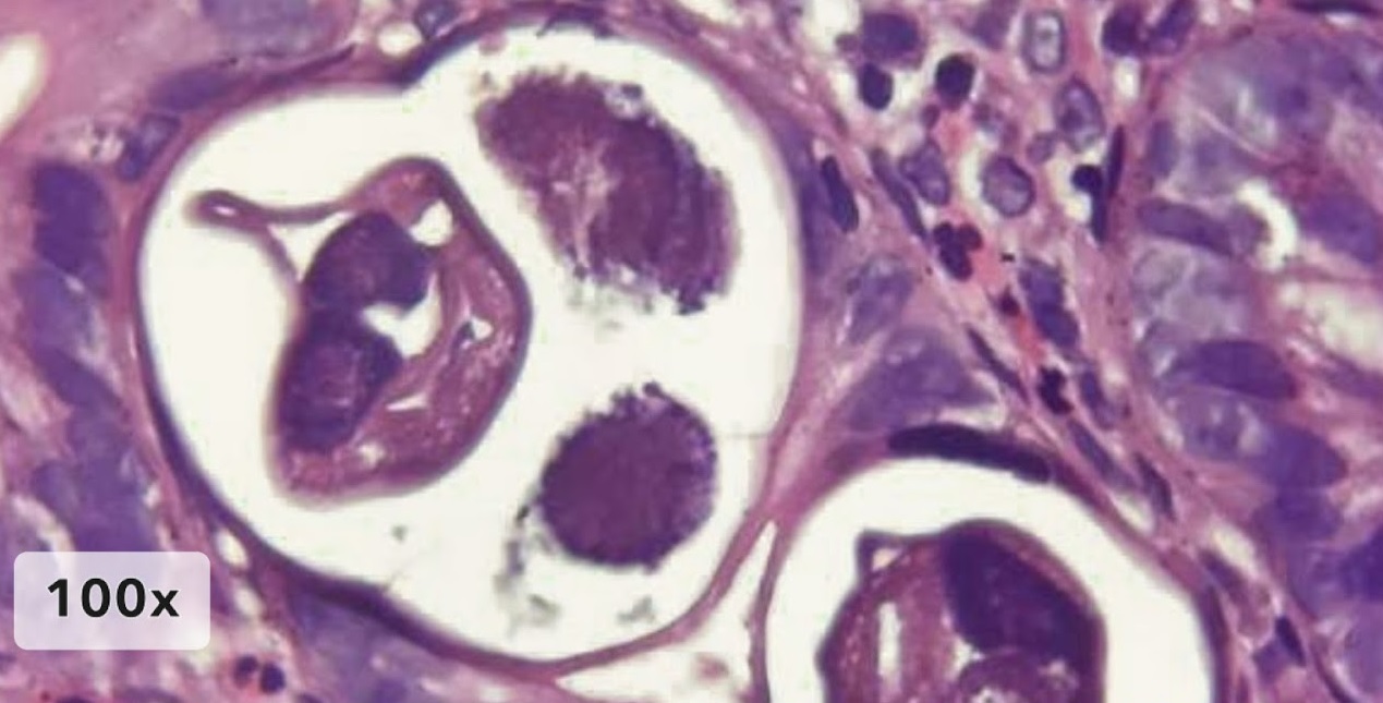 Patología Duodenal